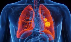 İleri evre akciğer kanserinde yeni tedavi umudu