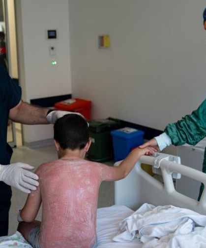 Aşırı sıcak çocuğu yaktı! İkinci derece yanık oluştu