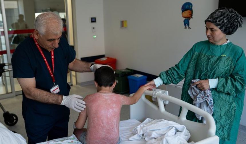 Aşırı sıcak çocuğu yaktı! İkinci derece yanık oluştu